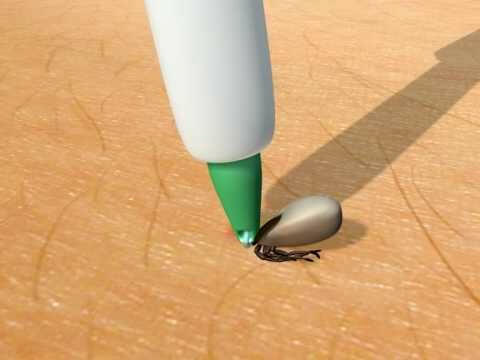 Trix - Tick Removal Lasso for People and Animals.